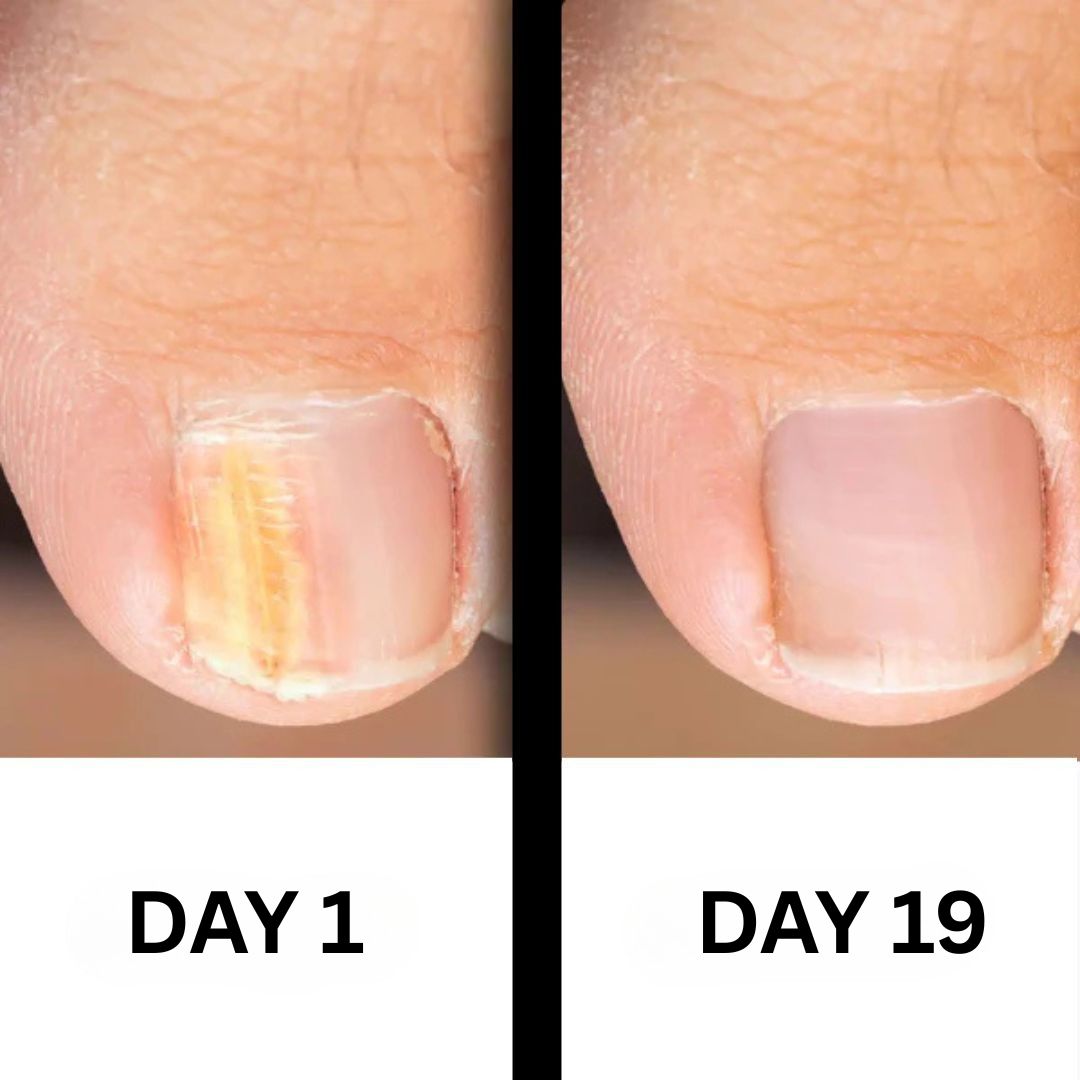 PureNail - Patented nail fungus therapy – for healthy nails within 4 weeks