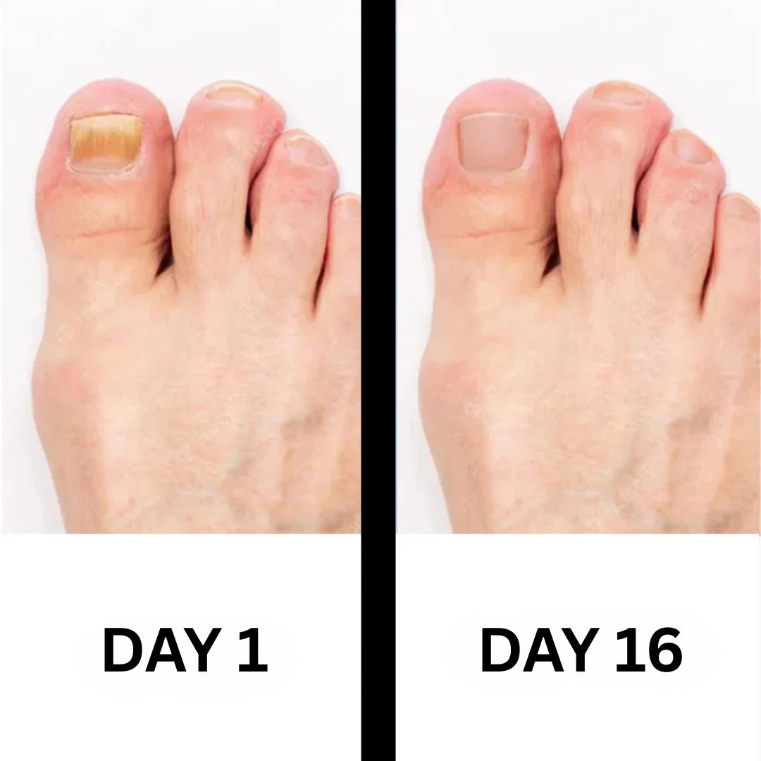 PureNail - Patented nail fungus therapy – for healthy nails within 4 weeks